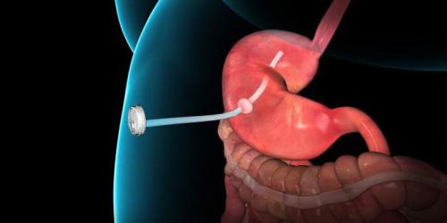 Каковы вероятные результаты лечения рака желудка 4 стадии. Современные методы лечения