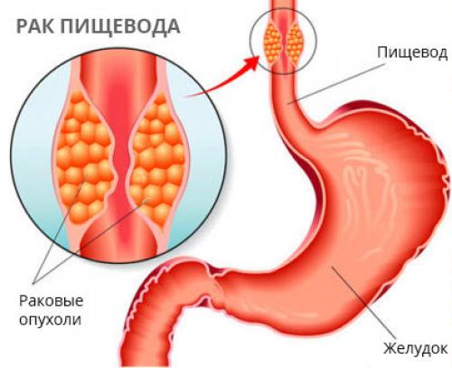 Как диагностируется рак пищевода и желудка. Факторы риска