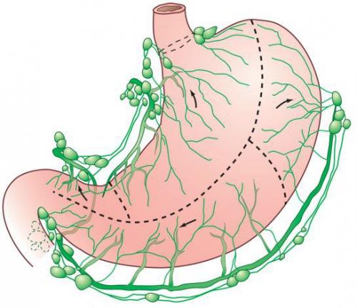 Как обнаруживается рак желудка