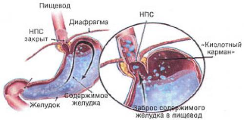 Кто лечит гастроэзофагеальную рефлюксную болезнь. Симптомы рефлюкс эзофагита 06 Кто лечит гастроэзофагеальную рефлюксную болезнь. Симптомы рефлюкс эзофагита 06