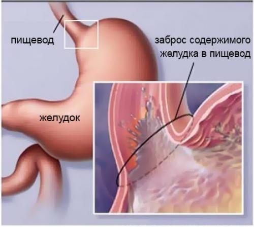 ГЭРБ считают болезнью современной цивилизации » Медвестник. 04 ГЭРБ считают болезнью современной цивилизации » Медвестник. 04
