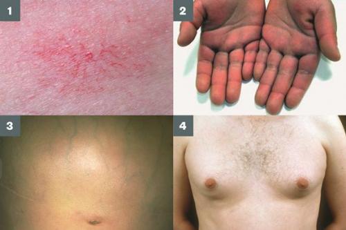 Функции печени в нормализации избыточного веса. Причины возникновения жировой болезни печени 02