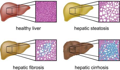 Функции печени в нормализации избыточного веса. Причины возникновения жировой болезни печени 04