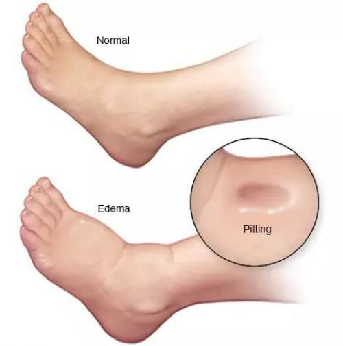 Функции печени в нормализации избыточного веса. Причины возникновения жировой болезни печени 01